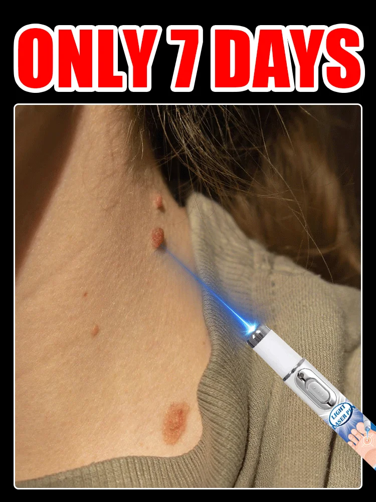 

hot sale wart care tools，blue light pen solve warts