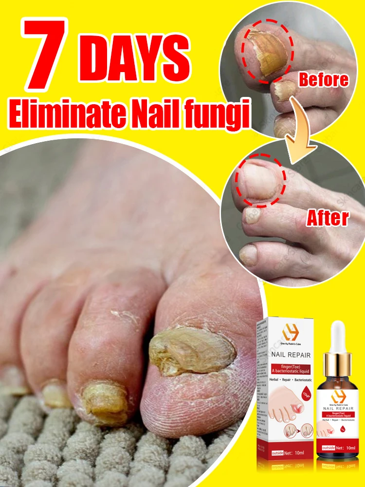 for solves nail troubles