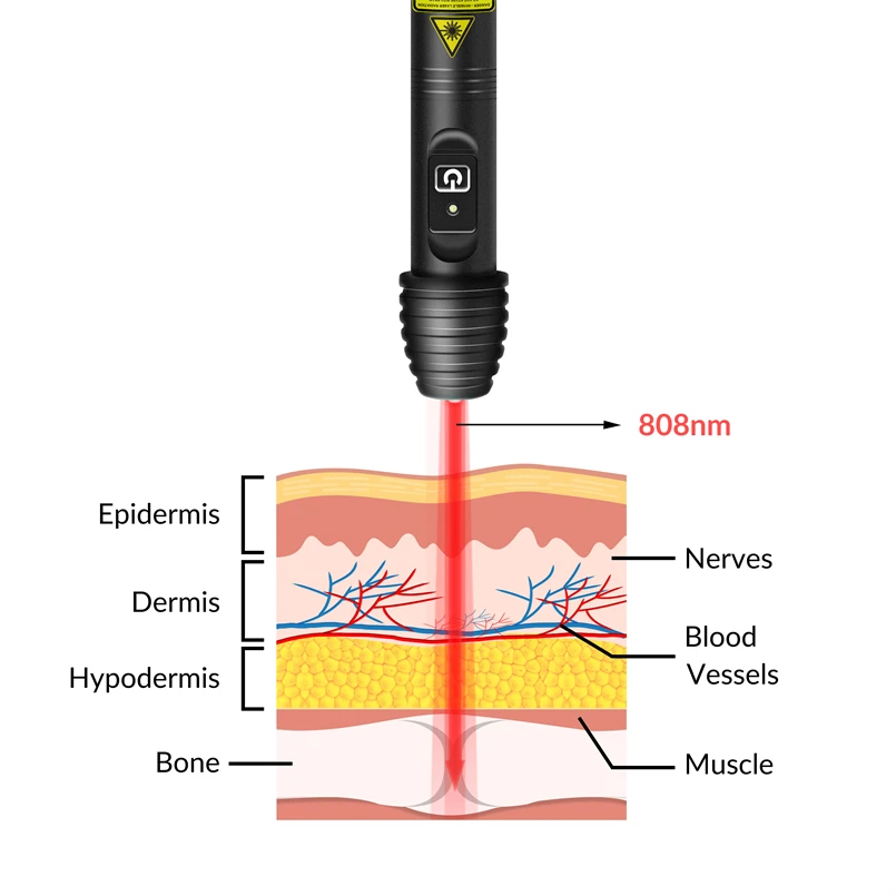 Terapia con láser único de 808nm para gatos, láser Clase 3 para el dolor de rodilla, terapia con láser de bajo nivel para inflamatorio de neuropatía de fibra pequeña