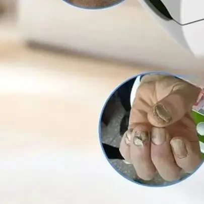 

Portable Dual-Wave (470nm+905nm) Nail Fungus Laser Treatment Device for Toenail & Fingernail, Painless Home Therapy