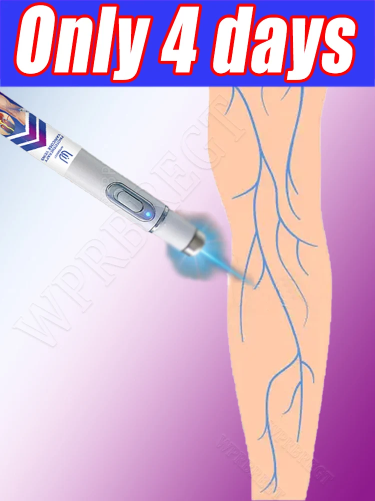 

Лазерная обработка варикозного расширения вен, лазерная ручка для вен