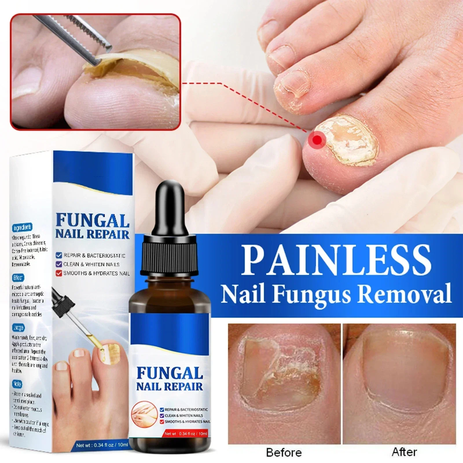 ⁿⁱᶜᵉ Toenail Nail Fungus Treatment Repair Fingernail Device Toenail Treatment for Foot Nail Fungus Essential Oil Onychomycosis C