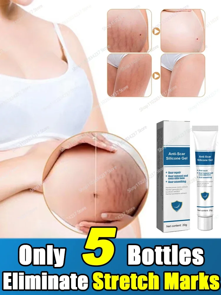 Pregnancy Stretch Marks Removal Eliminate Red White Old Stretch Marks Oil