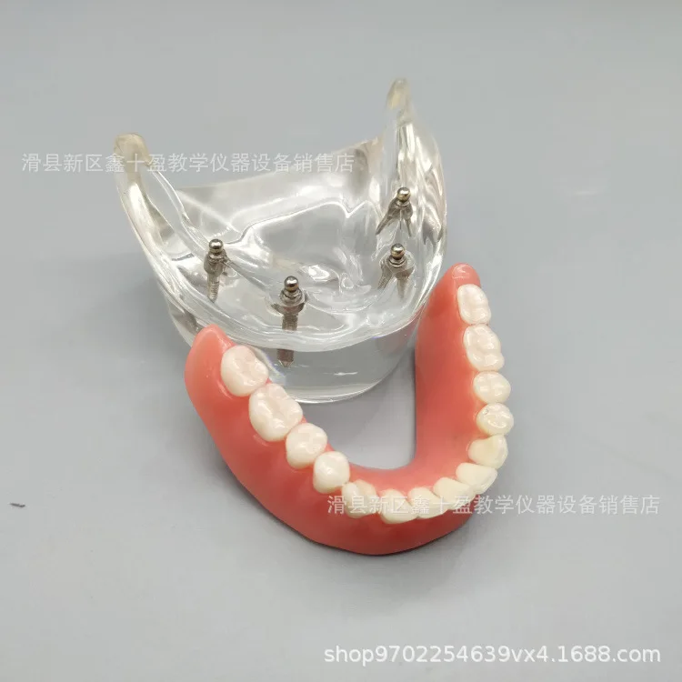 Dentalss 4-nail Model, Half-mouth Covering Denture Repair, Ball and Cap Combination, Four-nail Denture Model