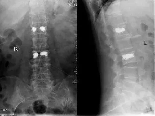 Percutaneous Vertebroplasty Thoracic Layer By Layer Puncture PVP Guide  Vertebral Perforator