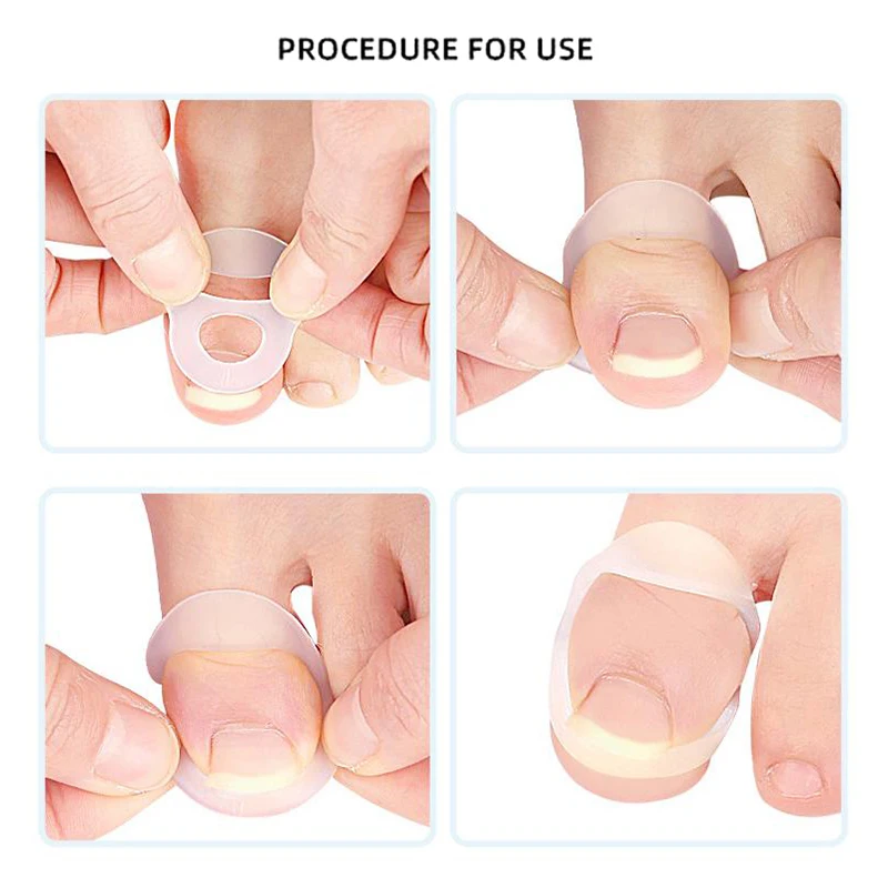 Silicone Ingrown Toenail Correction Tool Invisible Ingrown Toe Nail Treatment Elastic Straightening Clip Brace Pedicure Tool