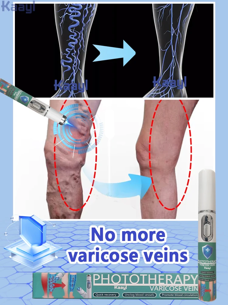 High Tech Laser Therapy Effective Relief Of Dilated Vasculitis In The Legs Phlebitis Health Improved Circulation New Product