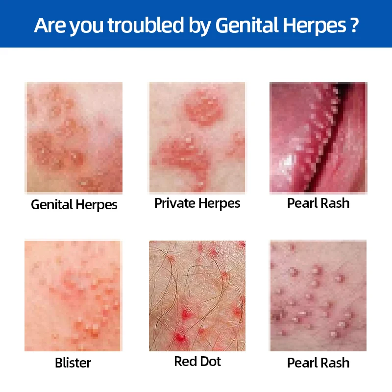 Genital Herpes Treatment Medical Spray Herpes Simplex Cure for Men and Women Shingles Medicine Cream CFDA  Approval 50ml/bottle