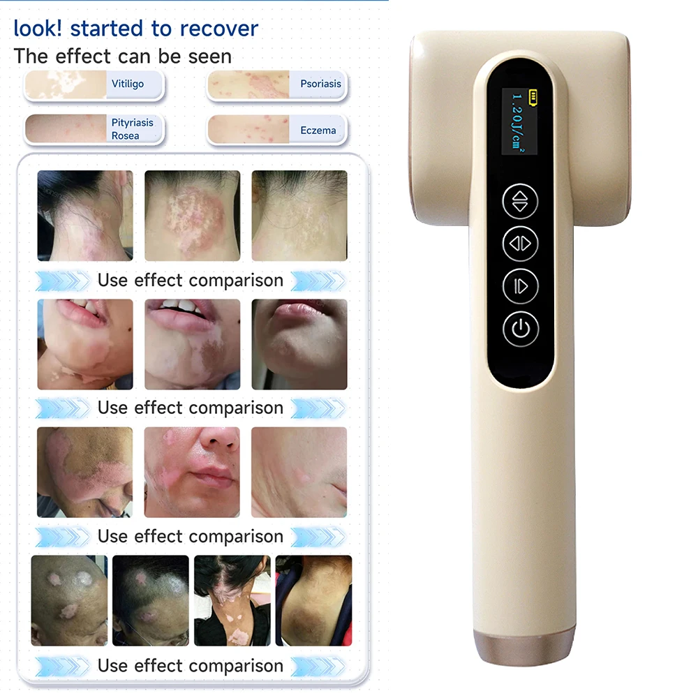 

308nm LED Light UVB Light Therapy UV Irradiation And Treatment of Vitiligo, Psoriasis, Pityriasis Rosea