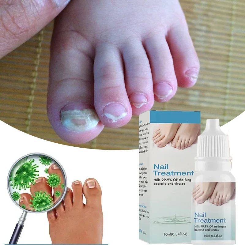 

10ml Onychomycosis Reparatie Serumzalf Onychomycosis Paronychia Zorgcrème Nagel Teennagel Voetverzorging Reparatie Essence Oil