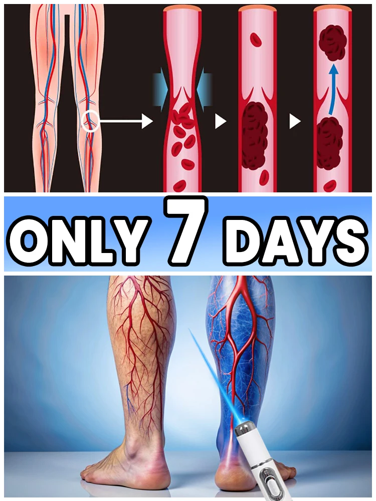 

Mini varicose vein blue light device: Painless leg care