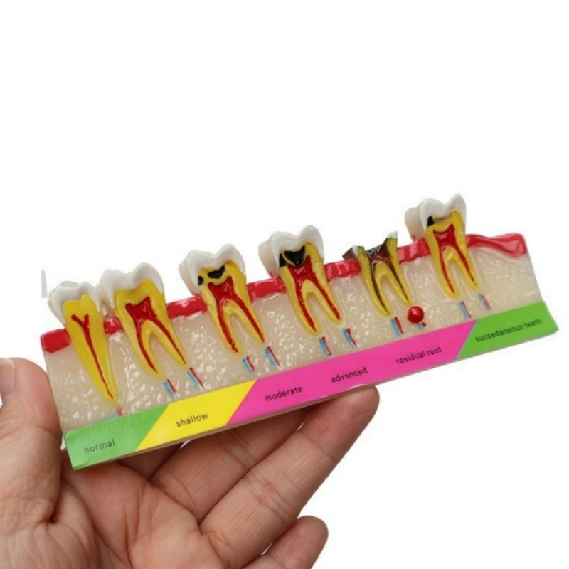 Dental Teaching Model Tooth Development Evolution Models Periodontal Disease Caries Demo Communication