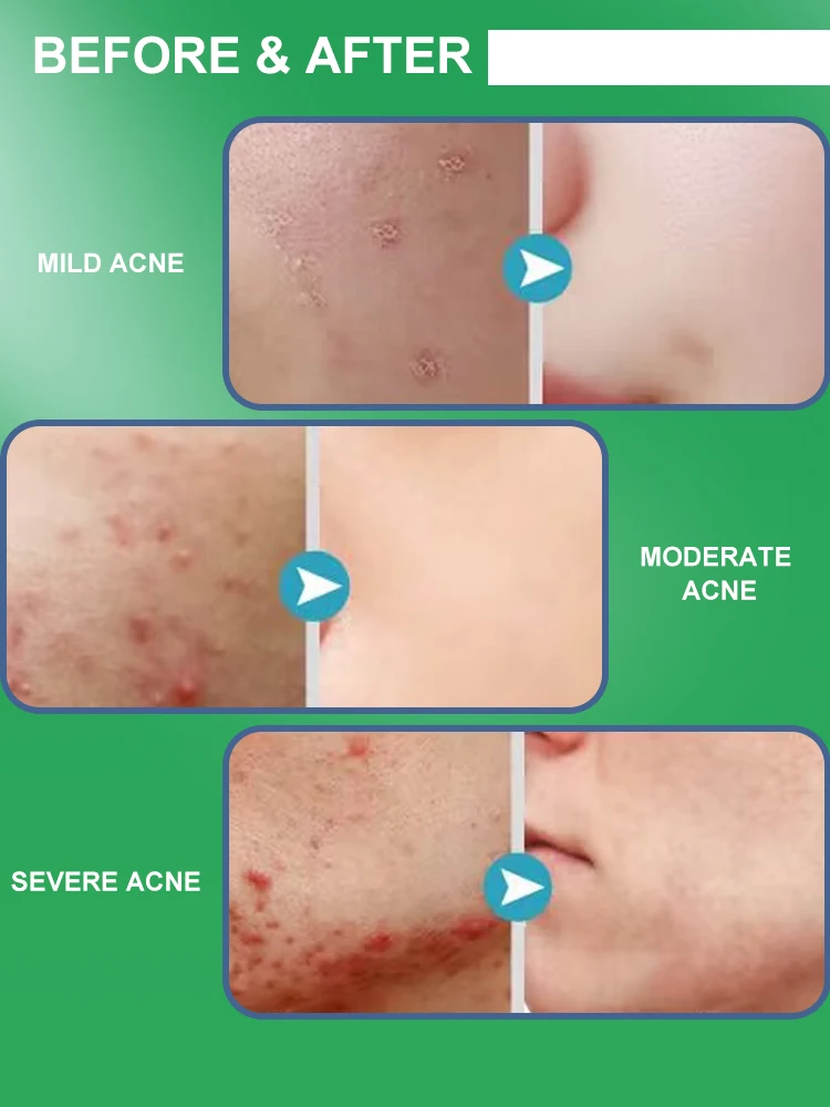 Vervagen Gezicht Acne