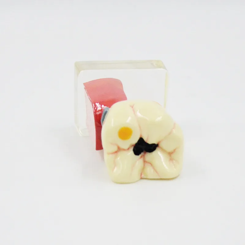 

Comprehensive pathological tooth decay model dentals anatomy dentistry