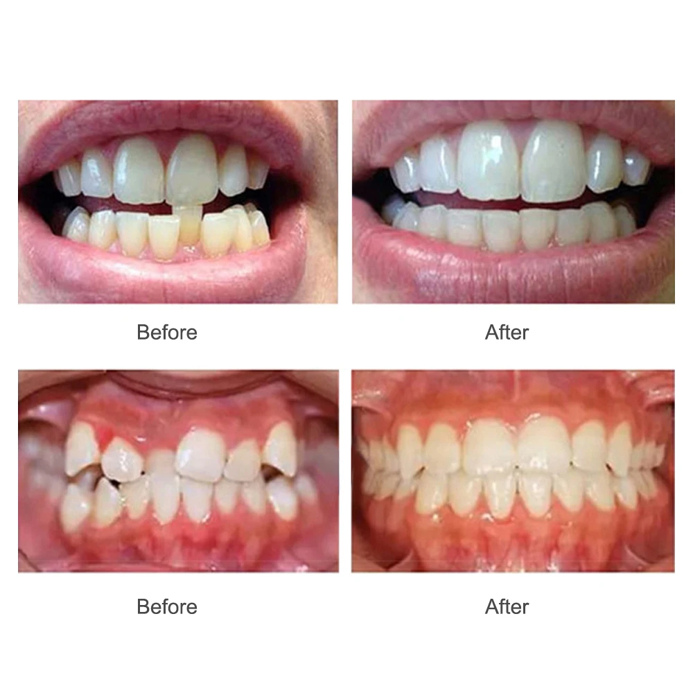 Dental Appliance Tooth Orthodontic Braces Trainer Dental Braces Teeth Trainer Alignment Braces Mouthpiece For Adults Orthodontic image 3