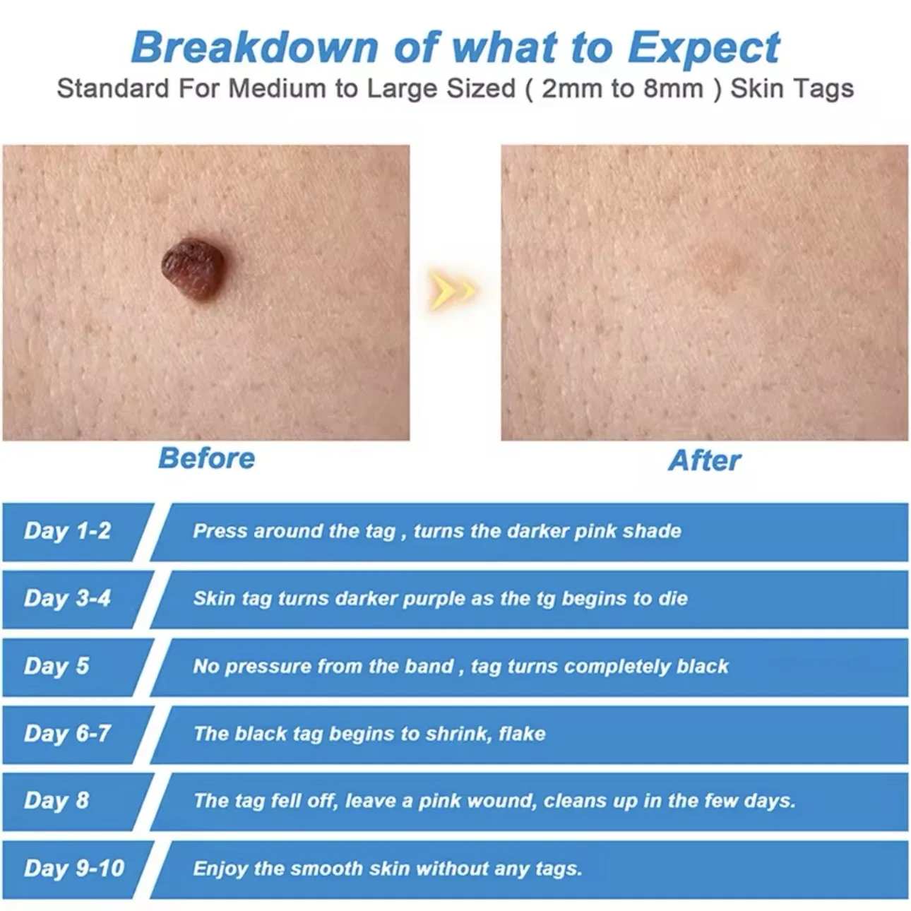 Automatic Micro Skin Tag Remover Standard and Micro Skin Tag Removal Kit Remover Facial Care Beauty Tool