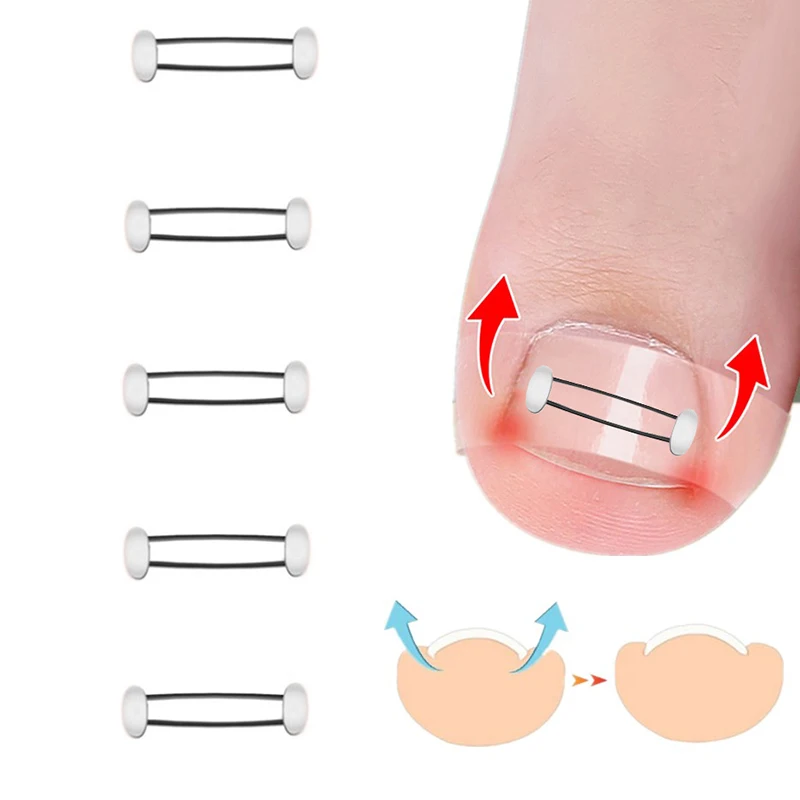 Ingrown Toenail Corrector Tools Pedicure Recover Embed Toe Nail Treatment Professional Ingrown Toenail Straightening Clip Brace