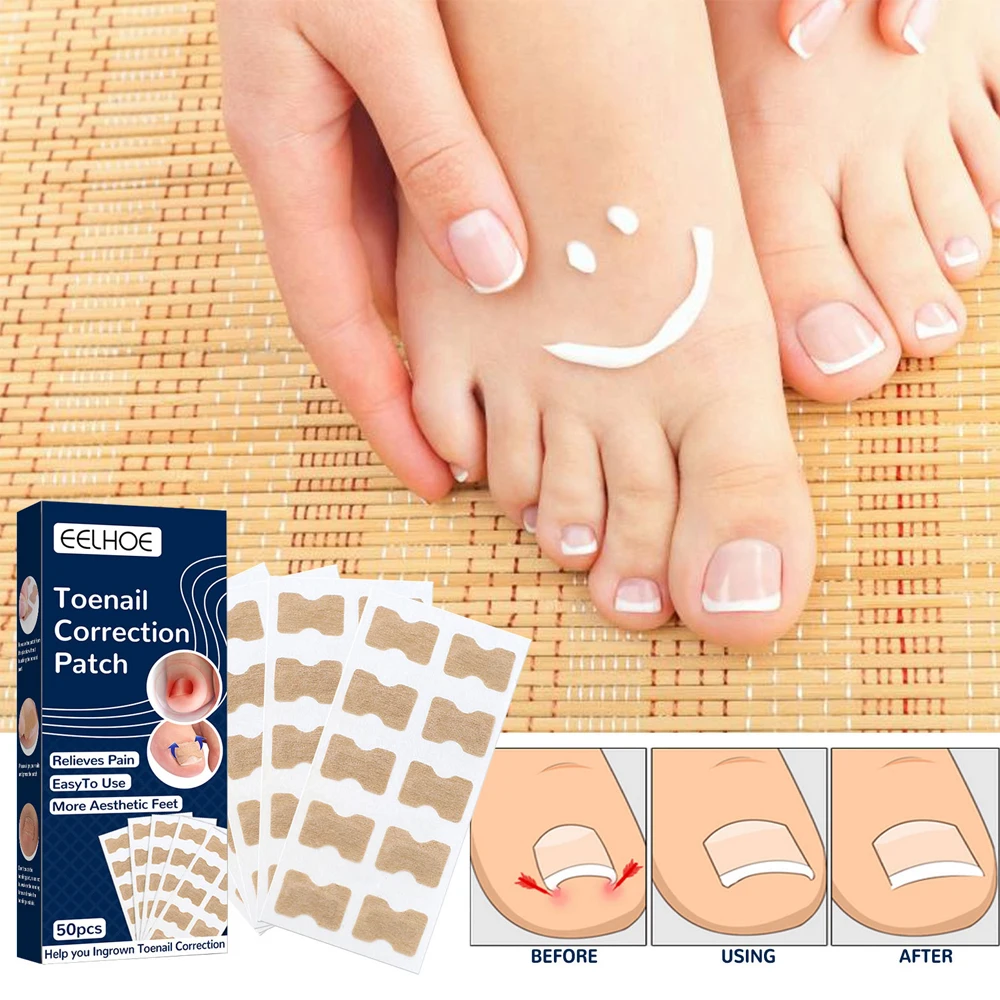 50pcs Nail Correction Stickers Ingrown Toenail Corrector Patch Waterproof Paronychia Treatment Recover Corrector Pedicure Tool