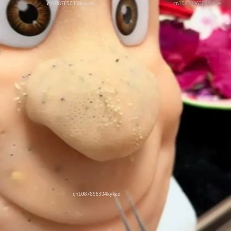 Squeeze Blackhead A…