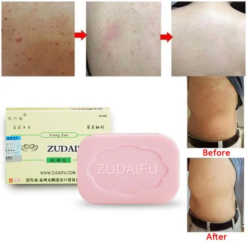 Zudaifu Sulfur Soap Cleanser Oil-Control Cure Face Whitening Sulfur Soap Skin Peel Cleanser Handmade Soap