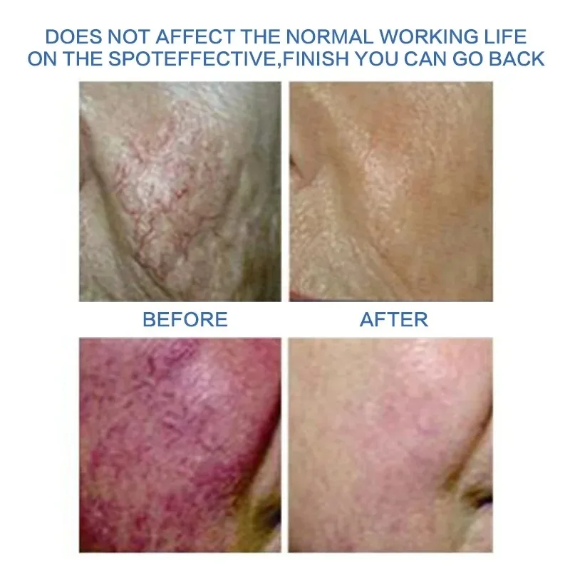 60W RF Vaso sanguigno rosso Rimozione vascolare Detergente per il viso Macchina di bellezza Ago ad alta frequenza Rimozione vene del ragno Strumento per la cura della pelle