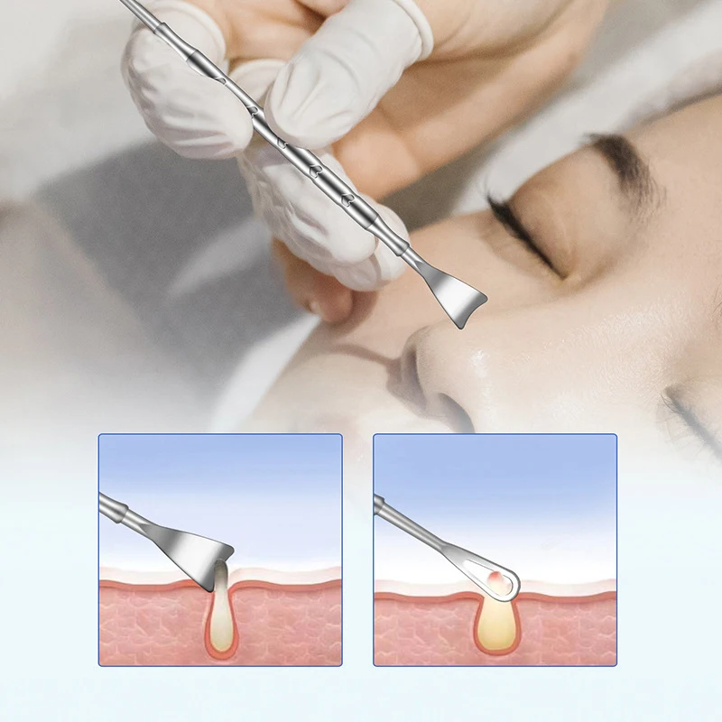 2 In 1 Puistje Popper Tool Mee-Eter Verwijderaar Acne Naald Verwijderen Behandeling Whitehead Popping Puist Neus Gezicht Vlek Extractor