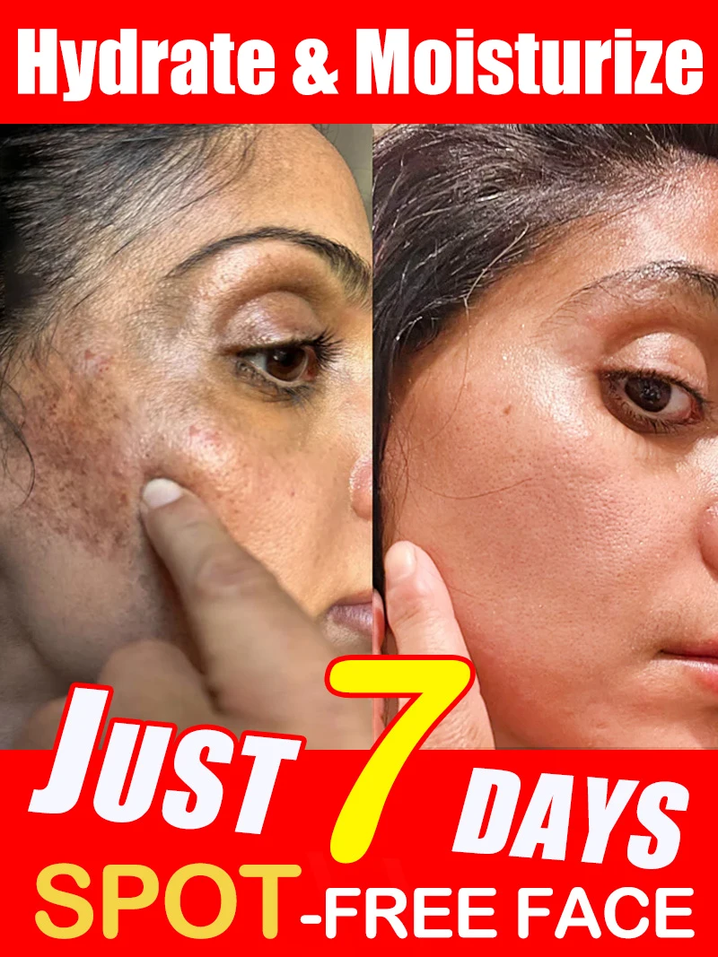 

Dark Sun Age Spots Freckles Chloasma Clear