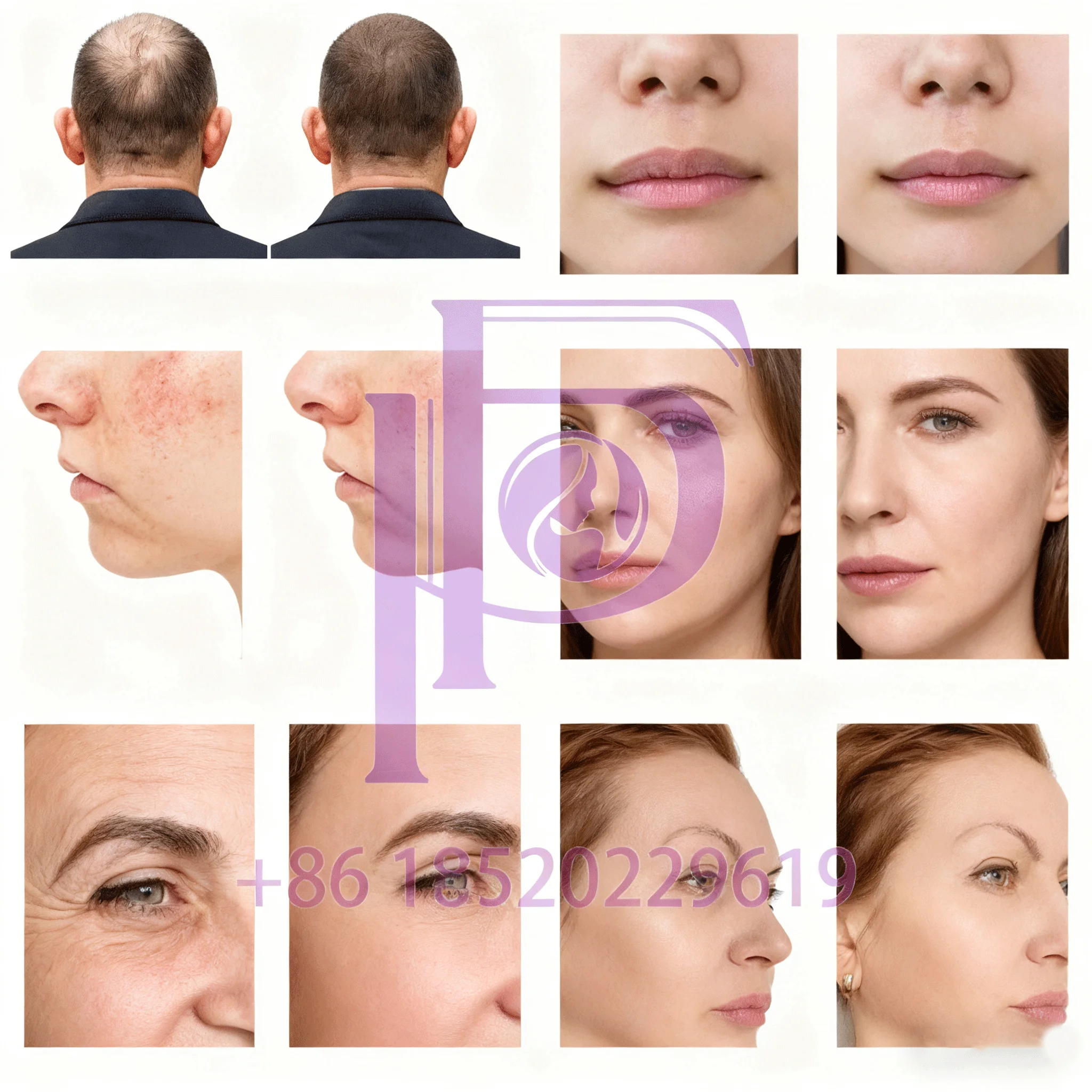 8-in-1 Fusion Plas/Ma Ozon Plasma Machine Koude Warme Modus Huidverstrakking Lifting Acne Verwijdering Huidverzorging apparaat