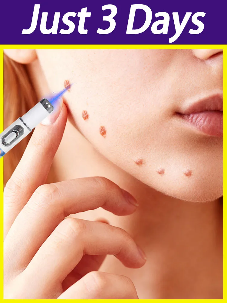 2025年新改良ブルーライトペンで、様々ないぼの問題を自宅で簡単に解決