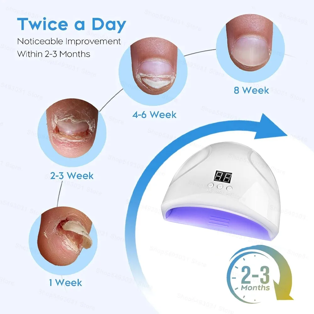جهاز علاج فطر الأظافر الفطري من تويناي ، إصلاح سريع ، فطر الأظافر ، علاج الأظافر ، ليزر الفطريات