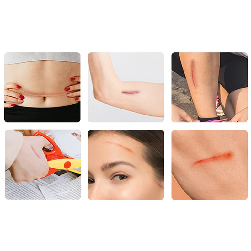 1 قطعة سستة التعادل الجرح إغلاق التصحيح المحمولة خياطة سريعة مرقئ التصحيح ضمادة مرنة في الهواء الطلق الإسعافات الأولية أداة العناية بالبشرة