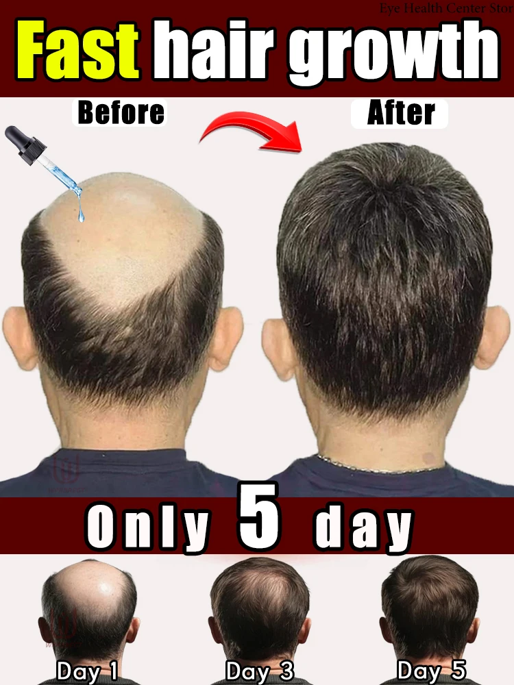 

WPRBREGT.BIue bottle.hair rowt essence 0iI.Say goodbye to baldness. The secret of thick hair hair growth essence