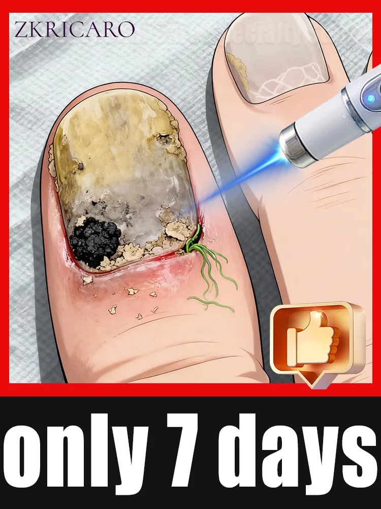 

The fifth generation of champagne-colored nail laser pen helps remove nail fungus, colorless and long-lasting sterilization