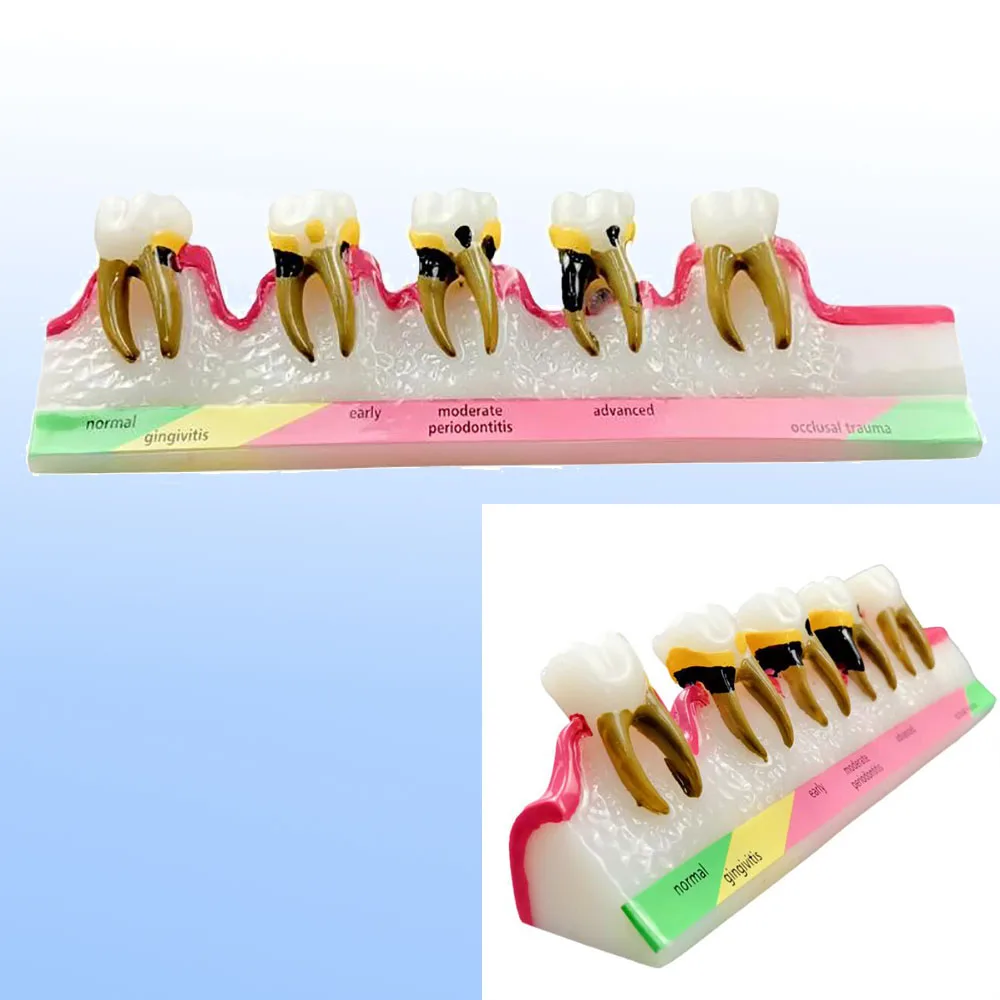 Dental Periodontal Disease Assort Demo Teeth Model 5 Stage Three-Dimensional Proportional Magnification Design for Dentist