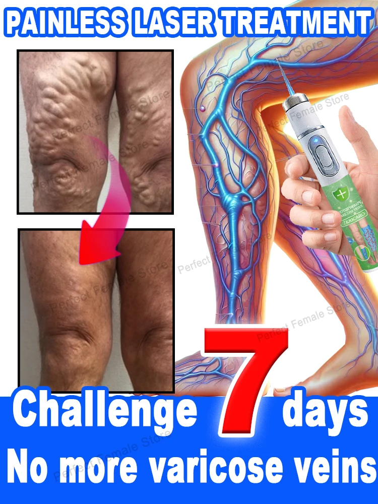 Varicose Veins Products