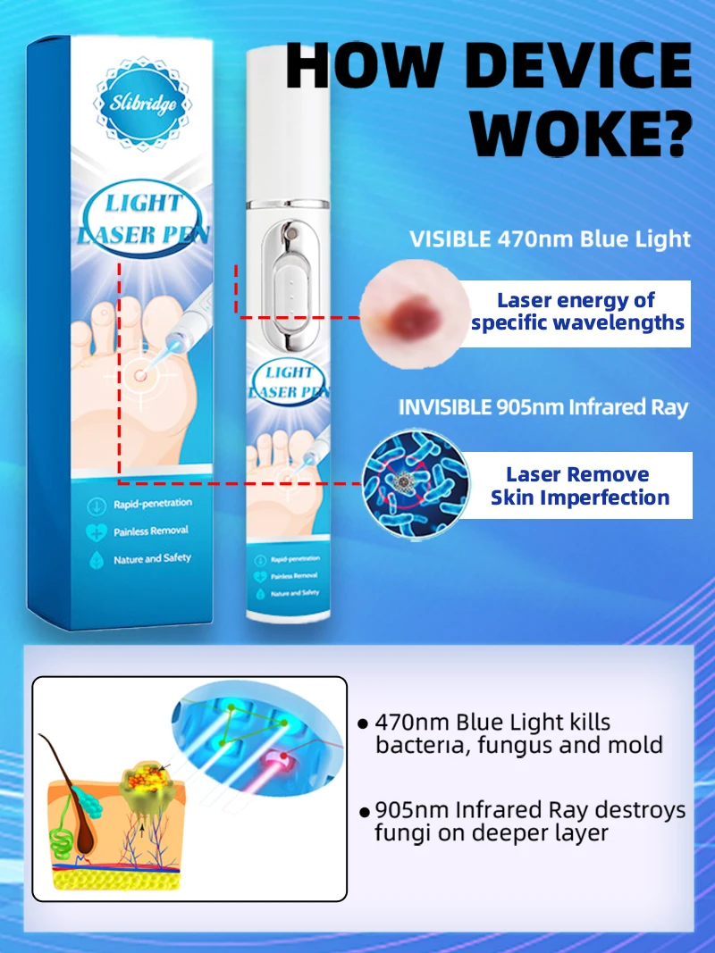 3세대 레이저는 7일 만에 사마귀와 작별을 이합니다