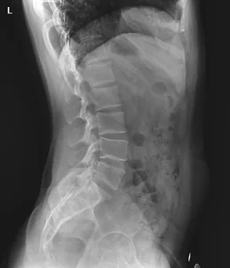 Hot Sale High Frequency Mobile Equipment Medical X-ray Machine