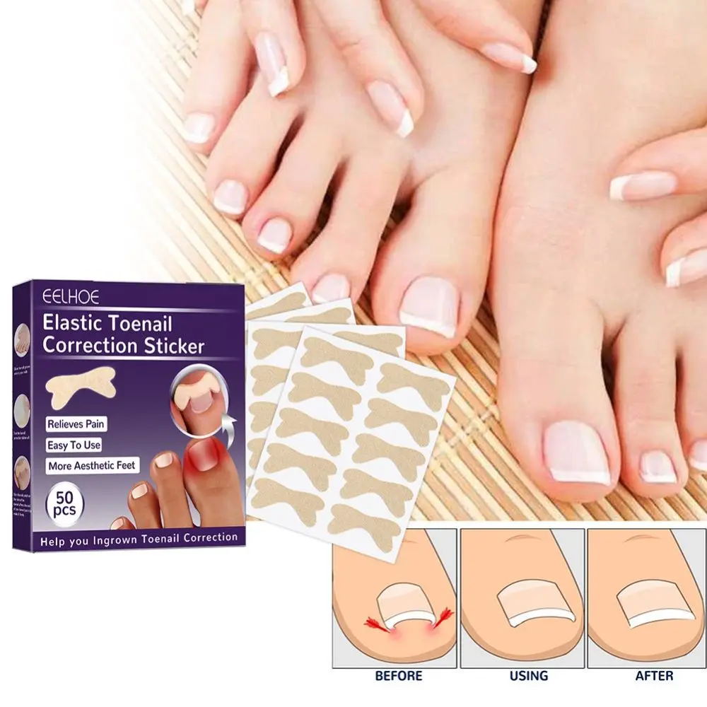 Corrector de uñas encarnadas a prueba de agua, pegatinas de corrección de paroniquia, parches correctores de uñas, herramientas de pedicura para salón de uñas