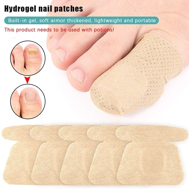 Parches para reparación de uñas de los pies, pegatinas de corrección encarnadas para el cuidado de las uñas descoloridas o dañadas, 10 Uds.