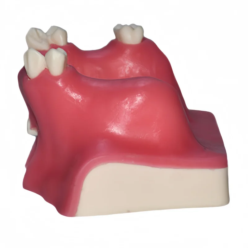 Dental Implant Teeth Model Oral Implantation Training Practice Model Teaching Exercise Dentist Doctor-Patient Communication Tool