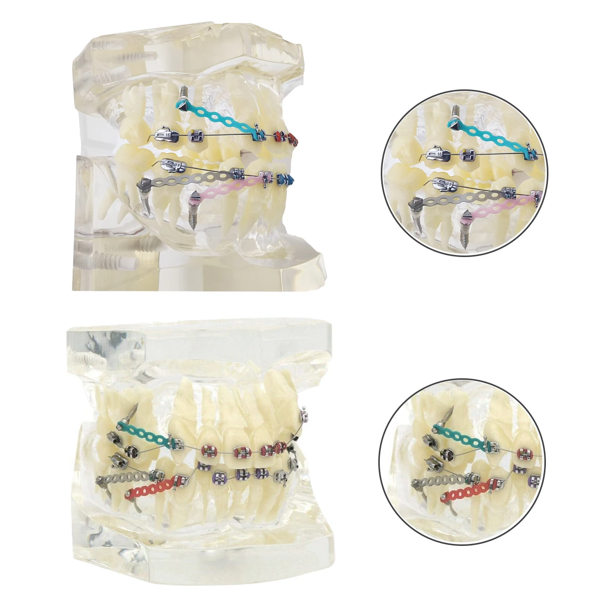 Dental Orthodontic Teeth Model Metal Brackets Arch Wires Ties Teach Models Clear Teeth Model Dentist Student Demo Studying