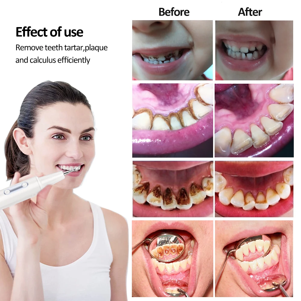 Rimozione del tartaro dentale elettrico ad ultrasuoni Scaler per denti irrigatore idropulsore dente orale rimozione del tartaro detergente per macchie di placca