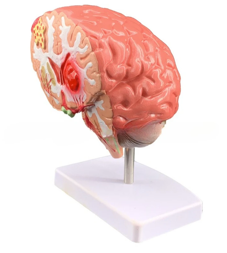Simulated human brain disease model, brain anatomy, neurosurgery model