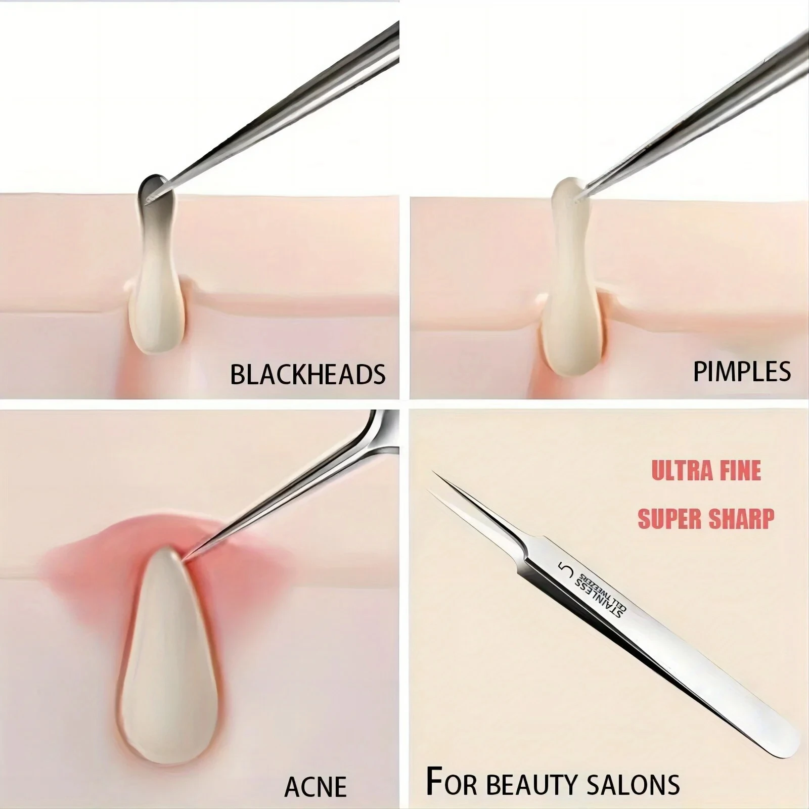 Luxury Skincare Acne - Higt Quality Acne Blackhead Removal Kit