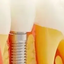 

Detachable Teeth Model 4 Times Implant Analysis Crown Bridge Demonstration for Student Teaching Study