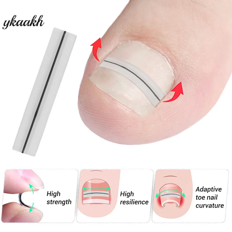 

Ingrown Toenail Correction Tool Straightening Clip Brace Ingrown Toe Nail Treatment Elastic Patch Sticker Pedicure Tool
