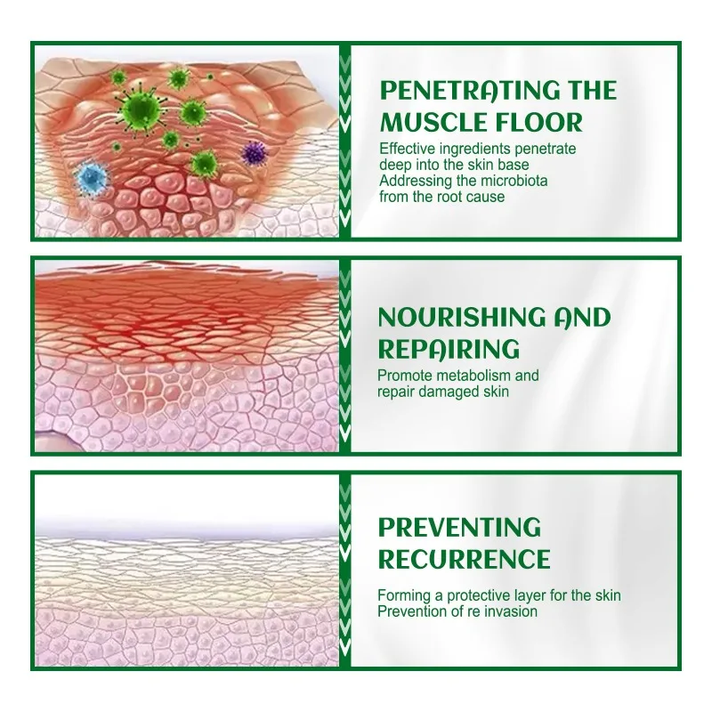 كريم بصيلات الشعر للعناية بالبشرة يقلل حب الشباب على الظهر وفروة الرأس ويخفف الحكة وينظف بصيلات الشعر