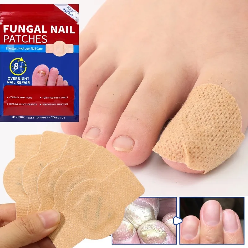 Nail Repair Patches Toenail Fungus Patch Sticky Toenail Care Nail Ingrown Correction Sticker Paronychia Disposable Toe Patch