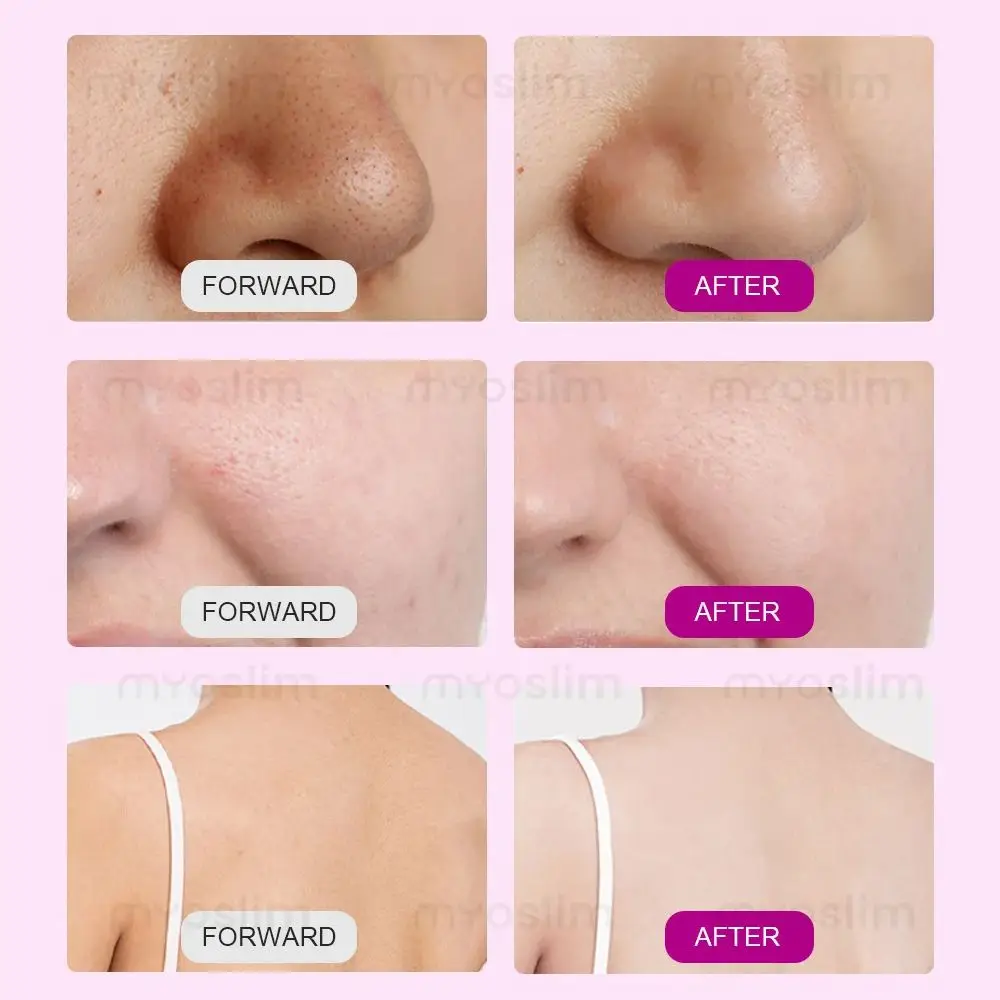 : Máquina facial de oxígeno y agua