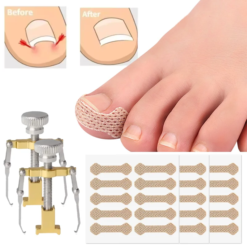 Corretor de unha encravada, clipe de alisamento, levantador de unha, paroníquia, remendo para pés, tratamento de pedicure, ferramenta de cuidados com os pés